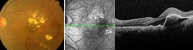 Dry Macular Degeneration img