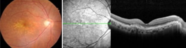 Wet Macular Degeneration img