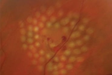  A retinal break was discovered and laser photocoagulation was performed img
